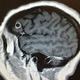 Imagen para el artículo titulado Esta mujer tuvo una enorme tenia viviendo un año en su cerebro, y fue la mejor noticia que le pudieron dar